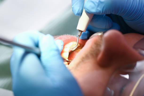 Best Emergency Treatment for Dental Infections or Abscesses in Vaville, CA